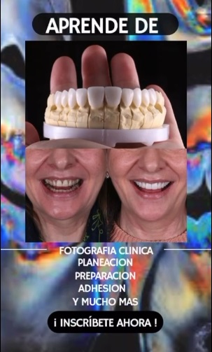 carillas
