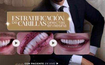 Estratificación de Carillas Directas en Resina